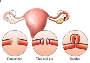 Sterilisation (Vasectomy or Tubal Ligation)