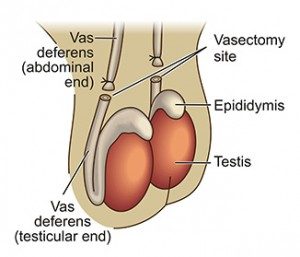 female sterilization